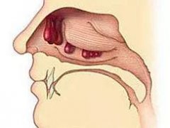 重庆好的耳鼻喉医院_鼻息肉该怎么预防