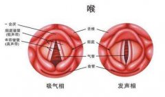 喉癌来临，身体会有4种＂危险信号＂！